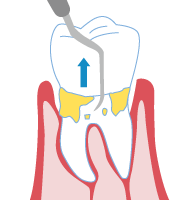 歯周病治療2