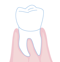 歯周病治療3