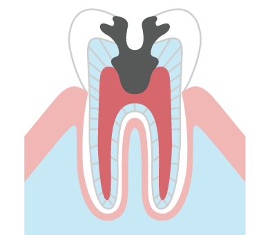 神経まで進んだむし歯（C3）